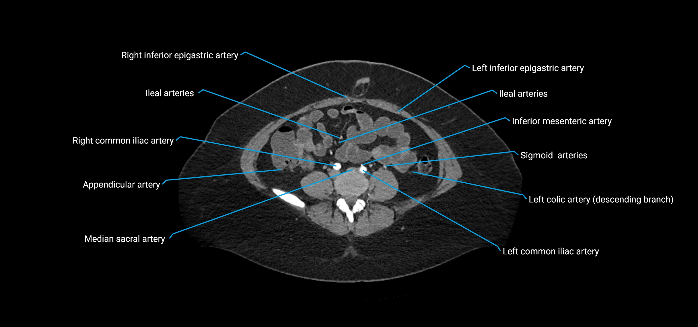 CTA abdomen axial cross sectional anatomy labelled image_152 (2).webp